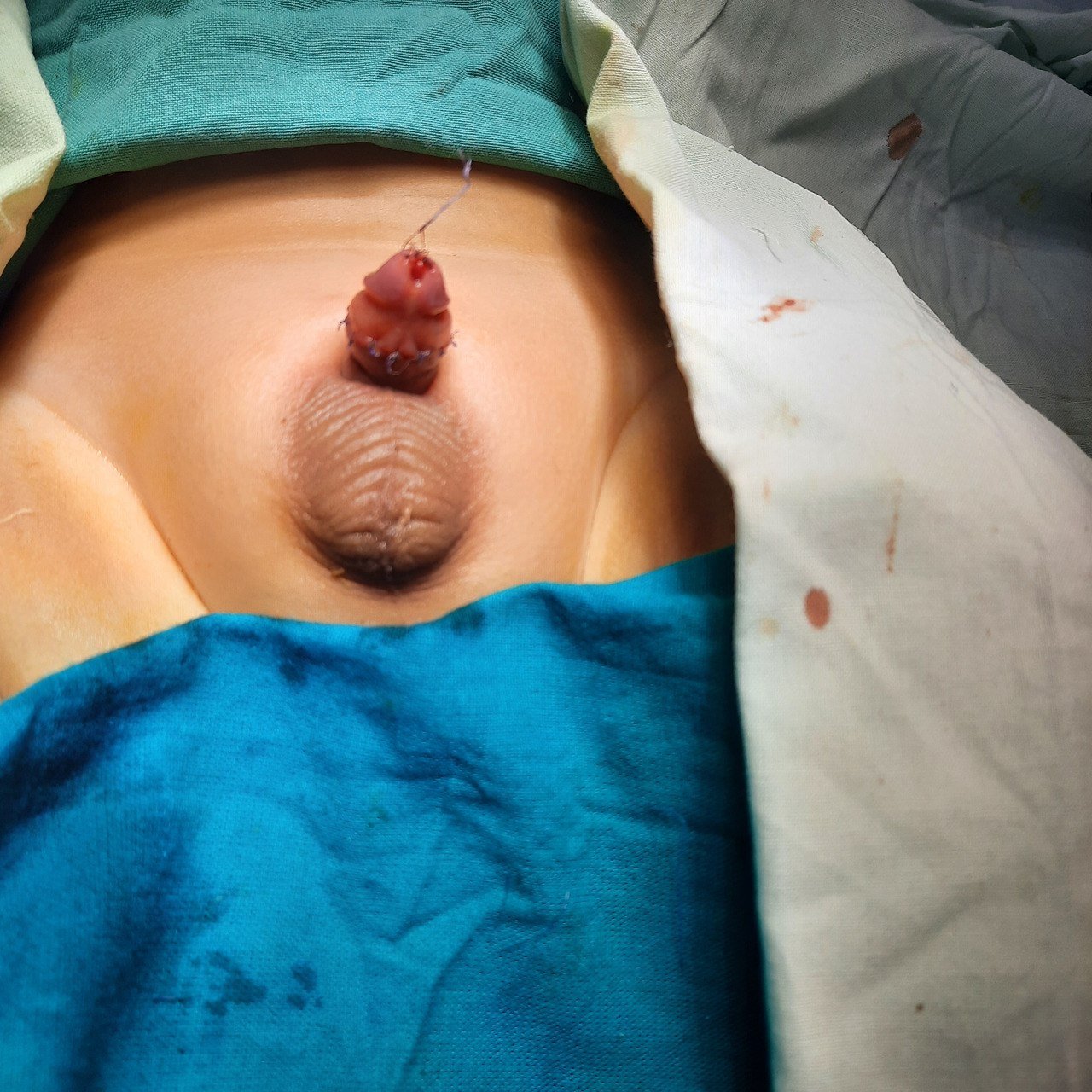 Buried Penis After Correction
