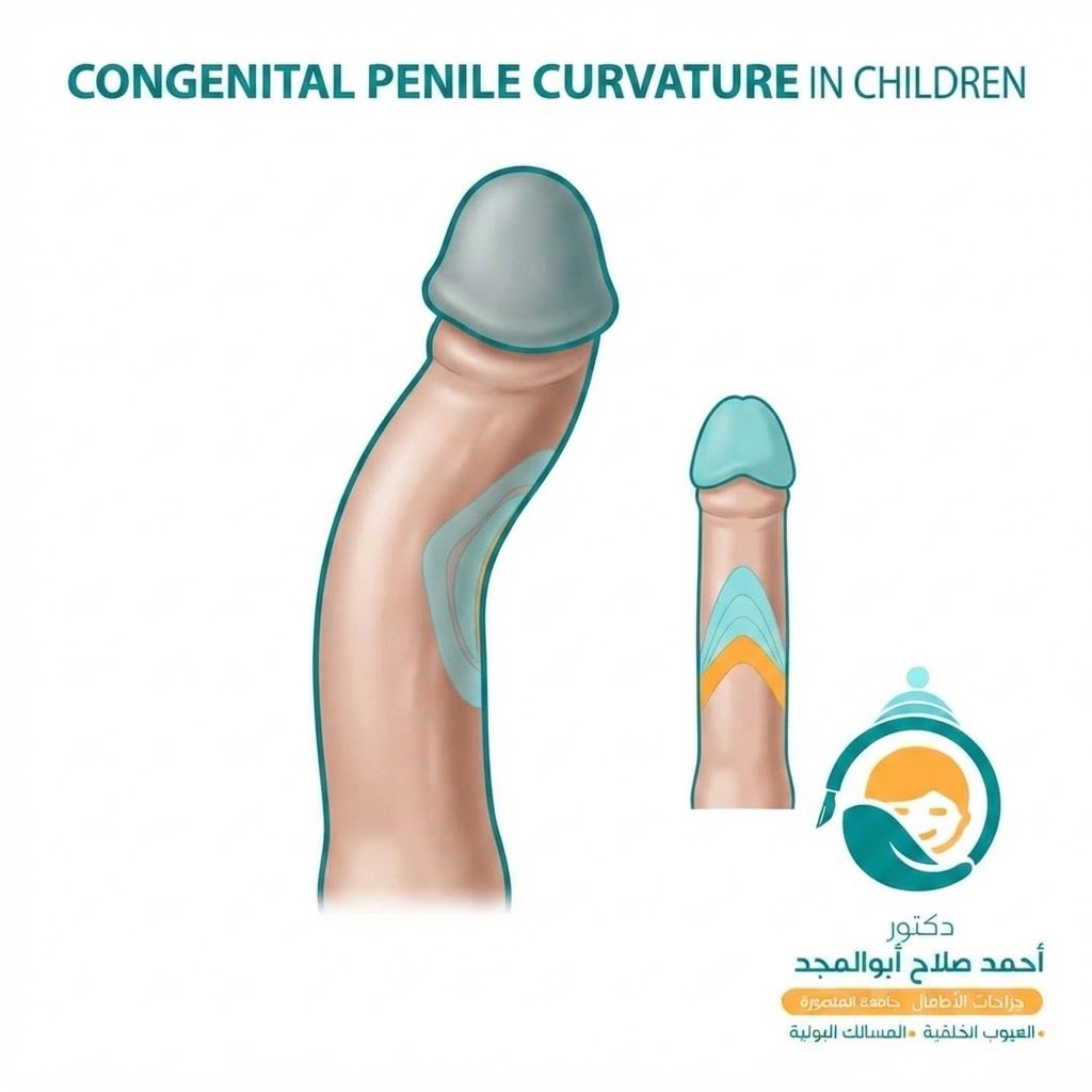 توضيح بصري توعوي لخدمة انحناء وميول العضو الذكري للأطفال - Canva
