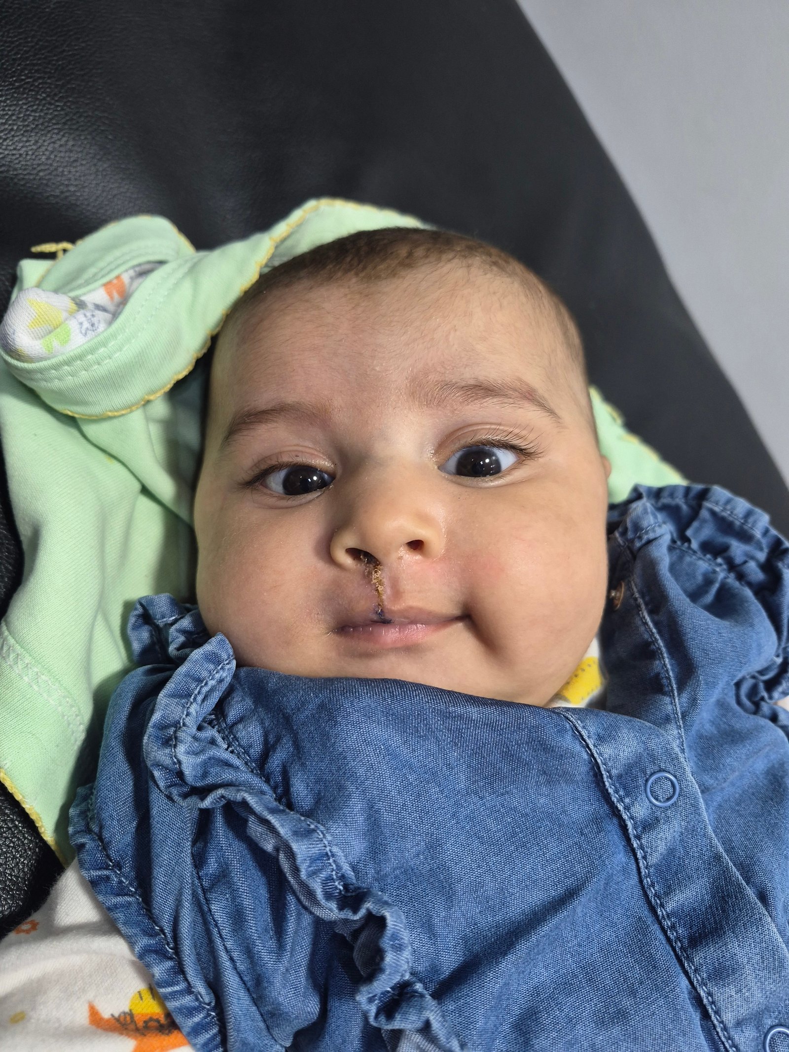 Maryam cleft lip repair postoperative result