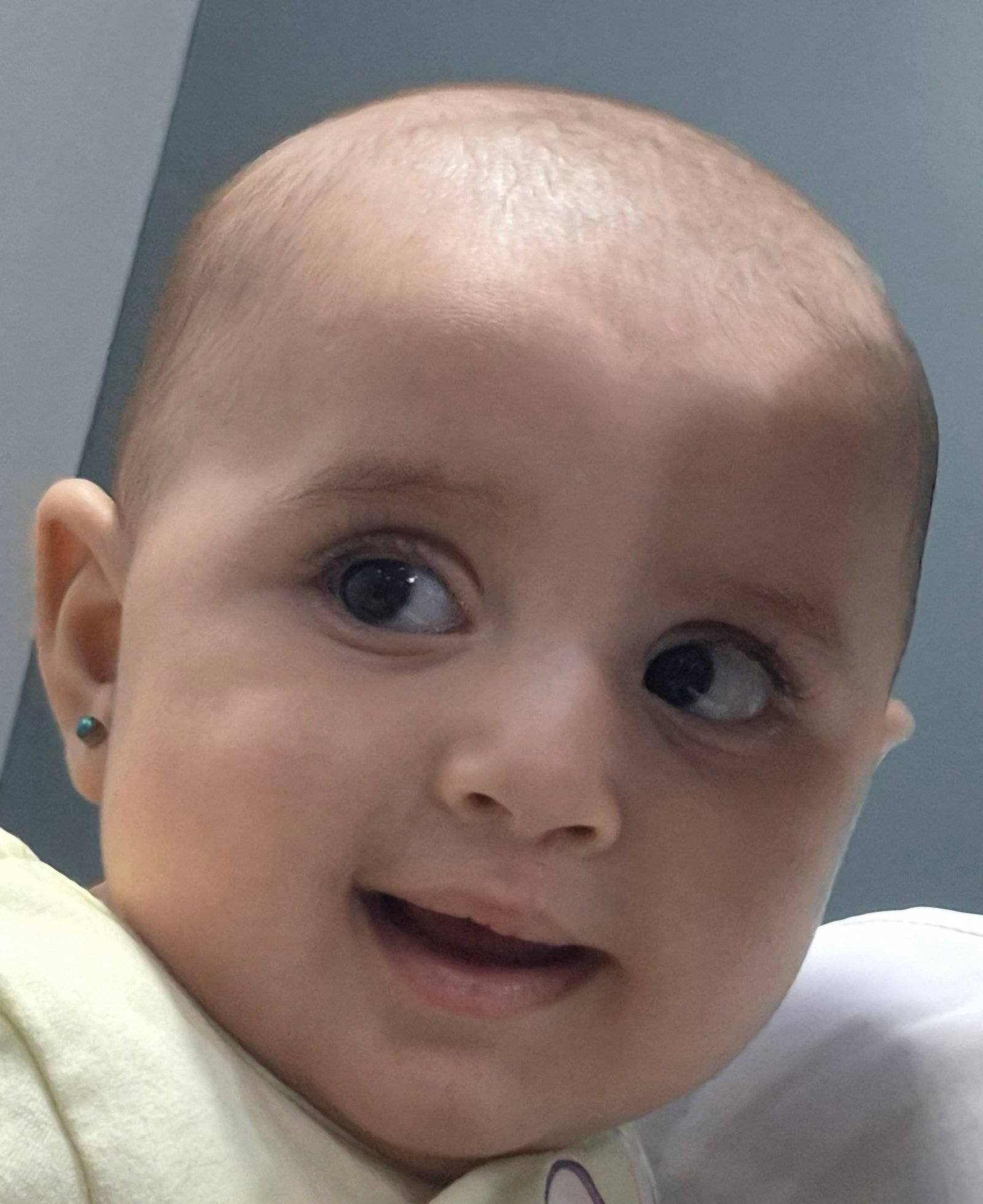 Maryam cleft lip repair 4 months postoperative outcome
