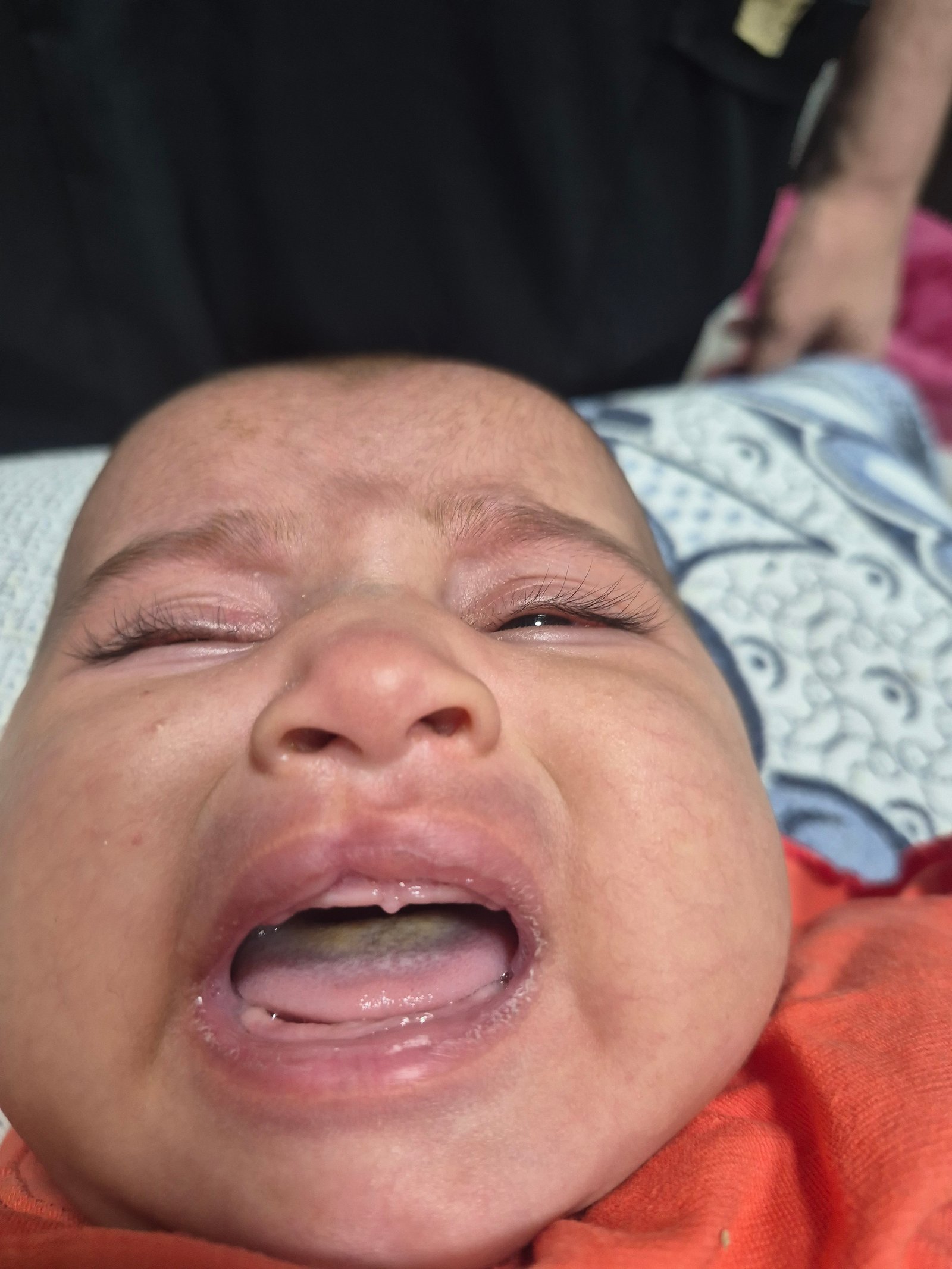 Maryam cleft lip repair case before surgery - view 1