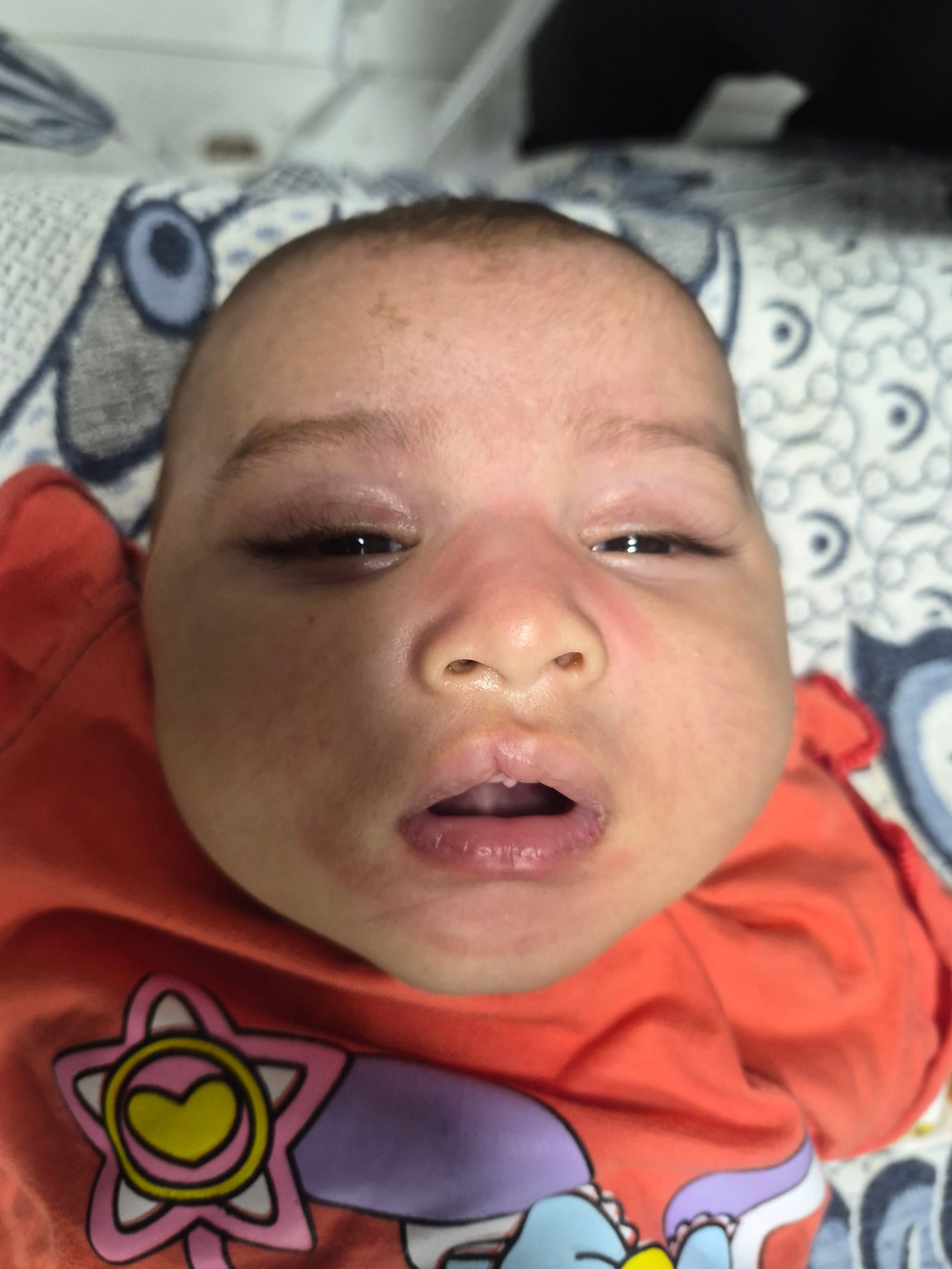 Maryam cleft lip repair case before surgery - view 2