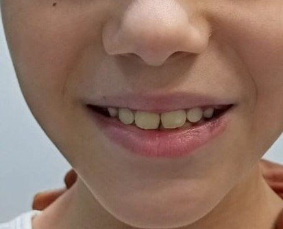 Lower Lip Hemangioma After Treatment