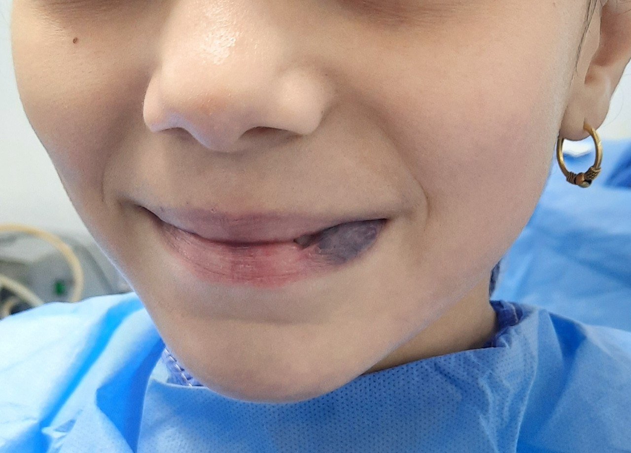 Lower Lip Hemangioma Before Treatment