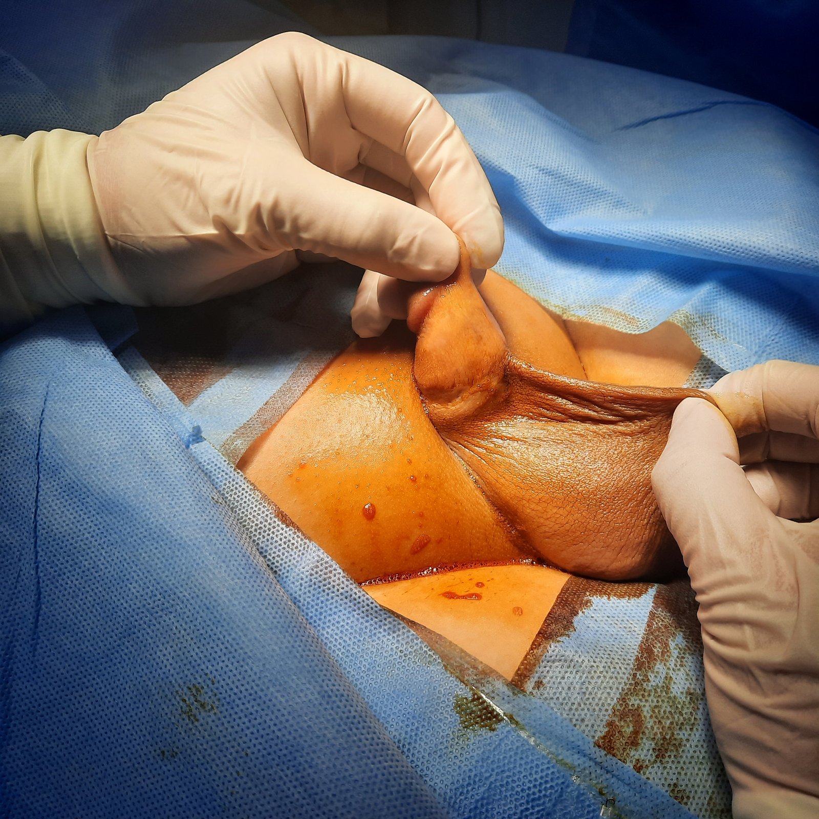 Overcircumcision Defect Before Revision