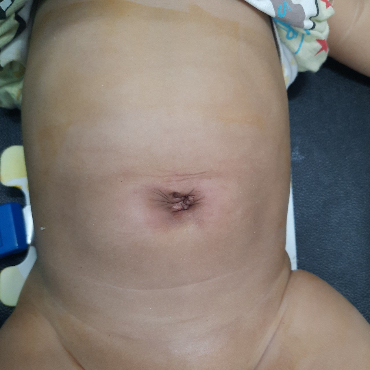 Umbilical Polyp After Excision