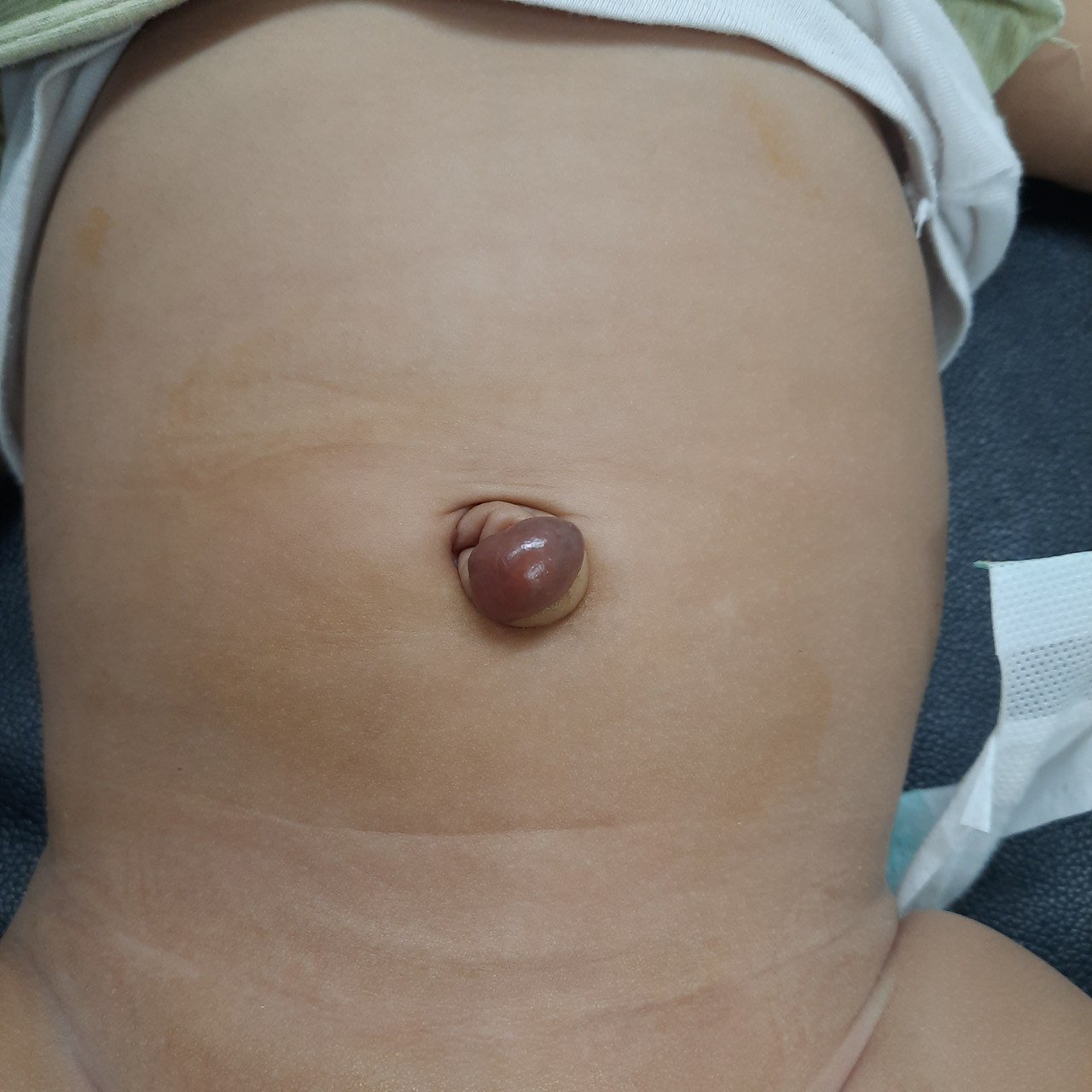 Umbilical Polyp Before Excision
