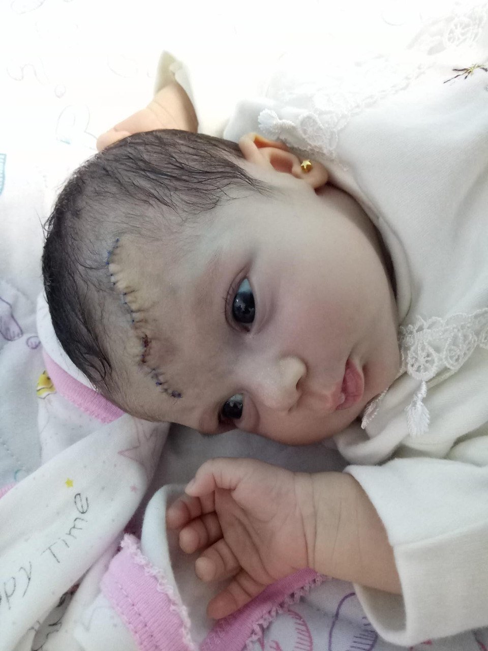 Forehead Vascular Malformation After Treatment