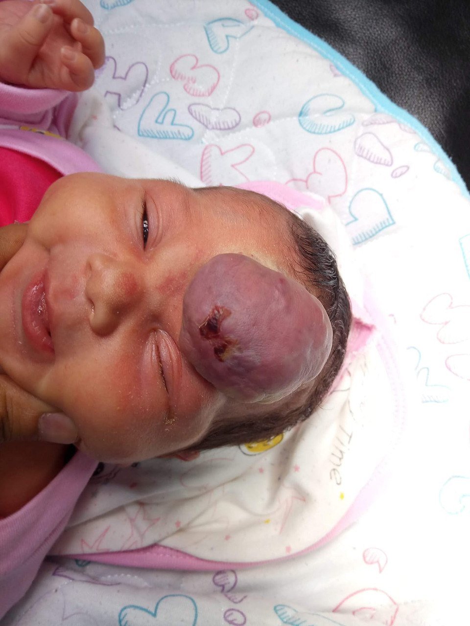 Forehead Vascular Malformation Before Treatment